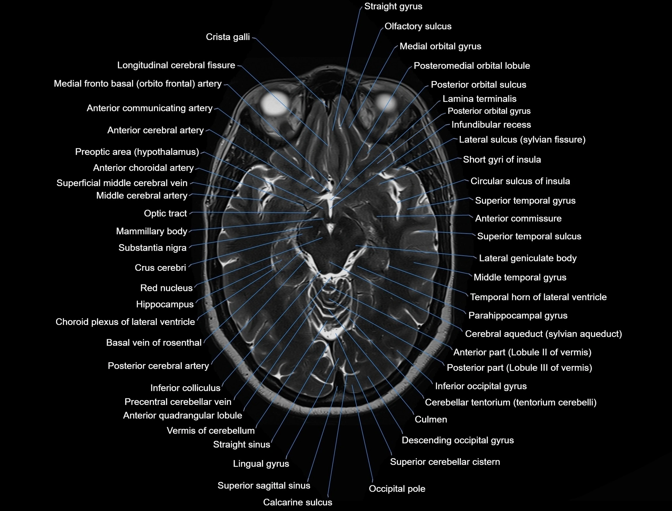 MRI Brain axial cross sectional radiology anatomy 3T image  -img-00001-00024.webp